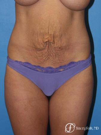 Denver Tummy Tuck - Abdominoplasty 8299 - Before Image 1
