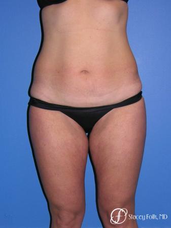 Denver Tummy Tuck Abdominoplasty and liposuction 4880 - Before Image 1