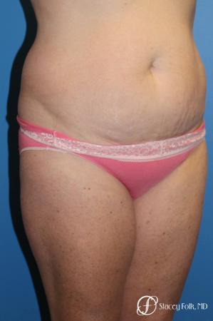 Denver Tummy Tuck 4817 - Before Image 2
