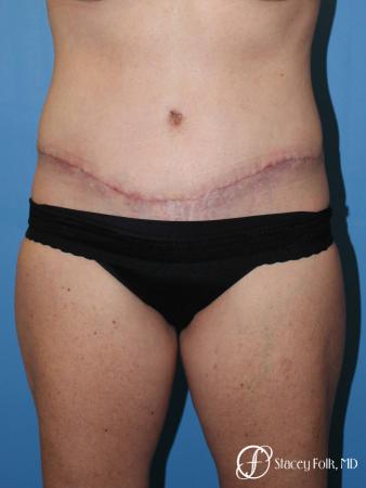 Denver Tummy Tuck 4817 - After Image 1