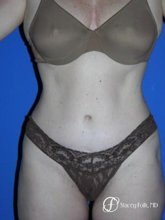 Denver Tummy Tuck 44 - After Image 1