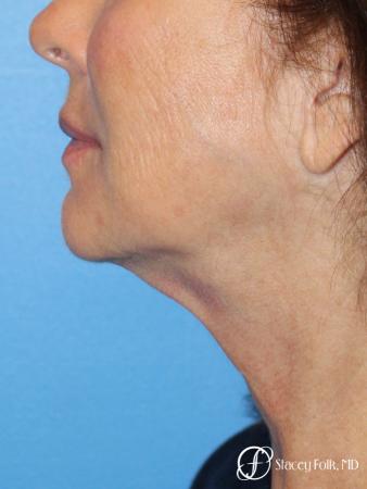 Denver Facelift & Laser Resurfacing 8277 - Before Image 1