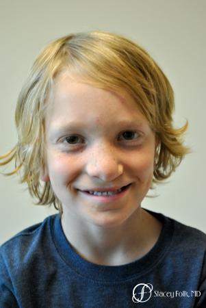 Denver Cleft Lip and Palate Repair 964 - After Image 2
