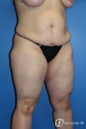 Tummy Tuck (Abdominoplasty) - Before Image 2