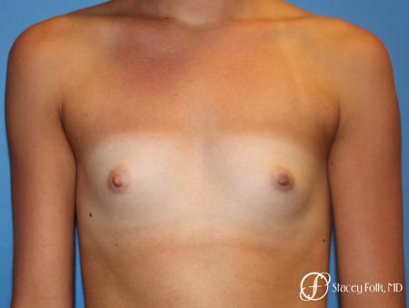 Denver Breast Augmentation with Sientra Breast Implants 9094 - Before Image 1