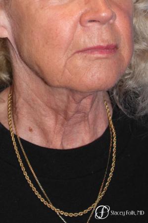 Denver Facial Rejuvenation Face lift, Fat Injections, and Laser Resurfacing 7131 - Before and After Image 4