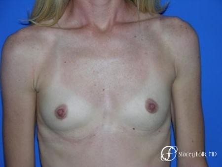 Denver Breast Augmentation 8 - Before Image 1