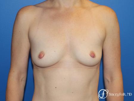 Breast augmentation with Natrelle Inspira breast implants - Before Image 1