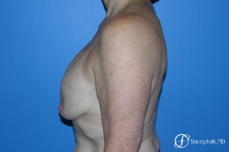 Denver Breast Revision 7990 - Before Image 3