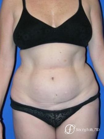 Denver Tummy Tuck 44 - Before Image 1