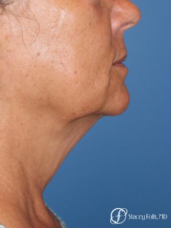Denver Facial Rejuvenation Face Lift, Fat Injection, Laser Resurfacing 7123 - Before Image 1