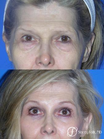 Denver Brow Lift and Upper Blepharoplasty 7161 - Before Image 1