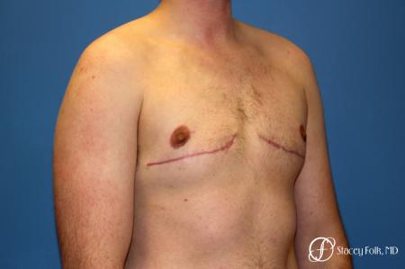 Denver FTM Female to Male Top Surgery 7708 - After Image 2