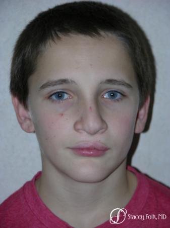 Denver Cleft Lip and Palate Repair 6187 - Before and After Image 2