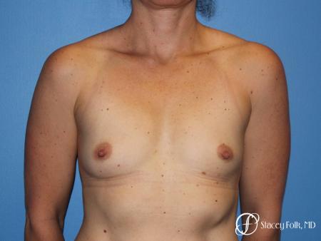 Denver Breast Augmentation 6611 - Before Image 1