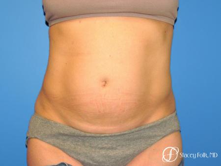 Denver Coolsculpting 8158 - Before Image 1