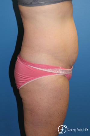 Denver Tummy Tuck 4817 - Before and After Image 3