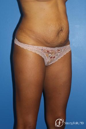 Tummy Tuck (Abdominoplasty) - Before Image 2