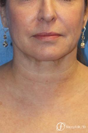 Denver Facial Rejuvenation 9894 - Before and After Image 2