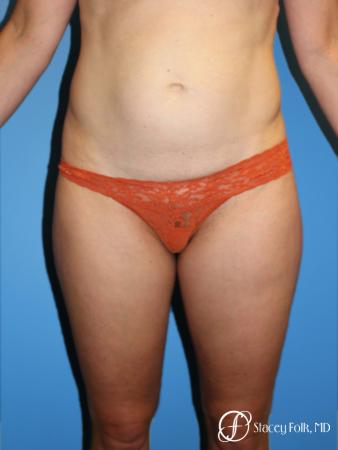 Denver Tummy Tuck - Abdominoplasty 8266 - Before Image 1