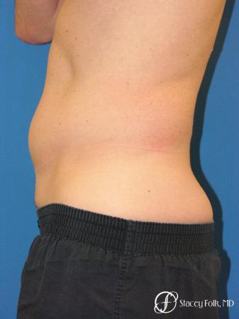 Denver Coolsculpting 5970 - Before and After Image 3