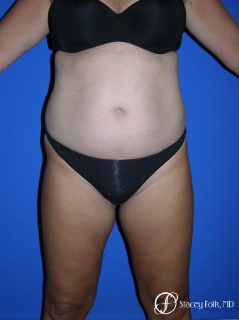 Denver Tummy Tuck - Abdominoplasty 53 - Before Image 1