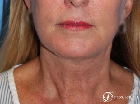 Denver Facial Rejuvenation 7916 - After Image 1