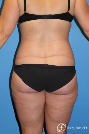 Denver Body Lift Belt lipectomy & liposuction 5264 - After Image 2