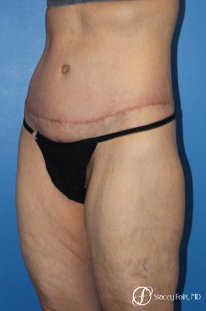 Denver Body Lift 10301 - After Image 3