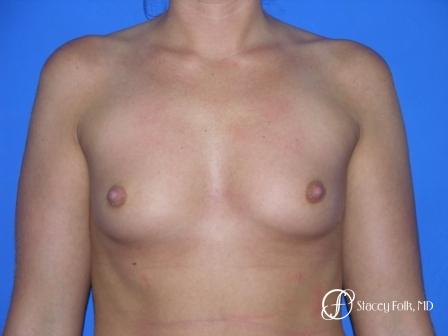 Denver Breast Augmentation 958 - Before Image 1