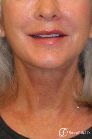 Denver Facelift & Laser Resurfacing 8277 - After Image 3