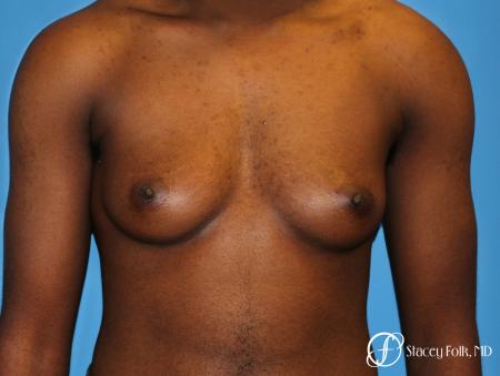 Denver FTM Female to male top surgery using gynecomastia technique 5497 - Before Image 1