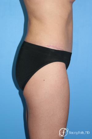 Denver Tummy Tuck - Abdominoplasty 7713 - After Image 3