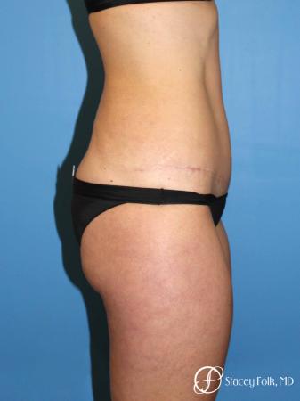 Denver Tummy Tuck Abdominoplasty and liposuction 4880 - After Image 3