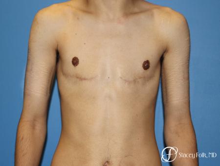 Denver FTM Female to male top surgery 5105 - After Image 1