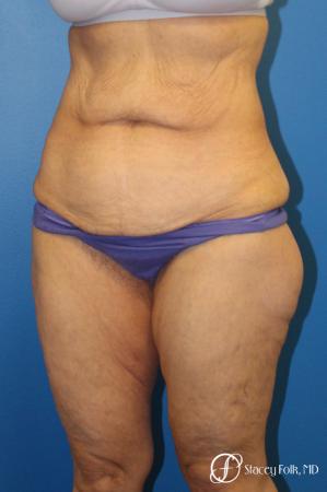 Denver Body Lift 10301 - Before Image 3