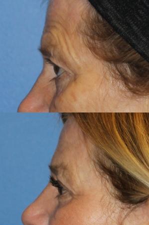 Denver Browlift and Blepharoplasty 11238 - Before and After Image 2