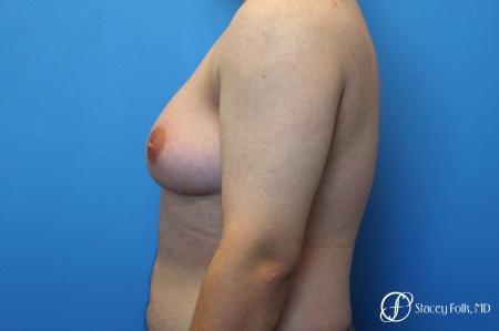 Denver FTM Top Surgery 5089 - Before Image 2