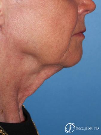 Denver Facial Rejuvenation Face lift, Fat Injections, and Laser Resurfacing 7131 - Before Image 1