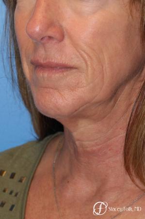 Denver Facial Rejuvenation Face lift, Fat Injections, and Laser Resurfacing 7132 - Before Image 2