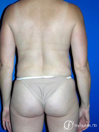 Denver Coolsculpting 8161 - Before Image 1