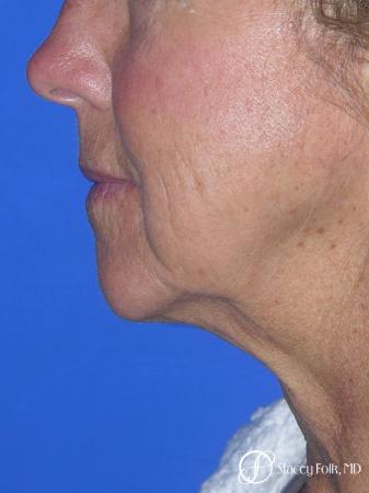 Denver Facial Rejuvenation Face Lift and Laser Resurfacing 7119 - Before Image 1
