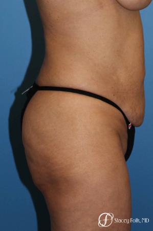 Denver Body lift 4818 - Before and After Image 3