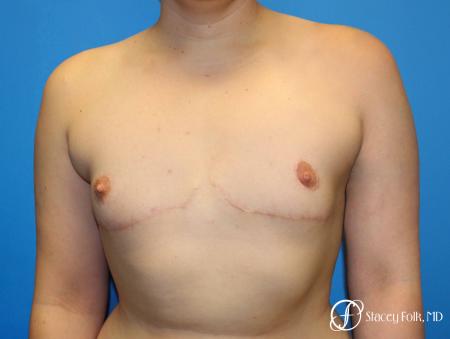Denver FTM Top Surgery 5088 - After Image 1