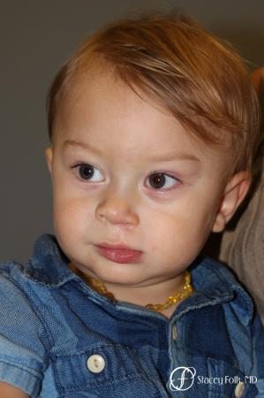 Denver Cleft Lip and Palate Repair 10314 - After Image 1