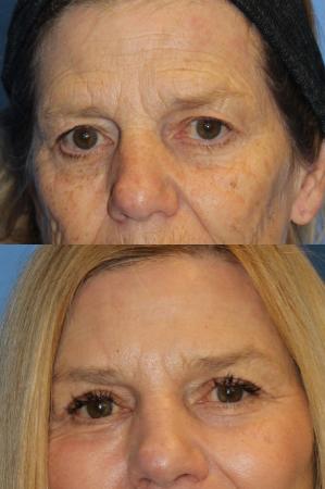 Denver Browlift and Blepharoplasty 11238 - Before Image 1