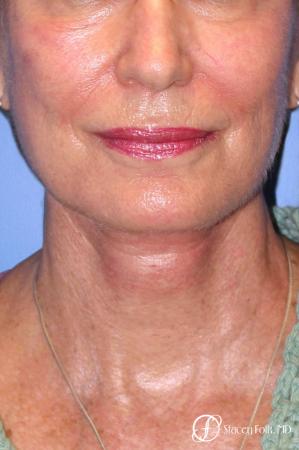 Denver Facial Rejuvenation Face Lift, Fat Injections, Laser Resurfacing 7116 - After Image 3
