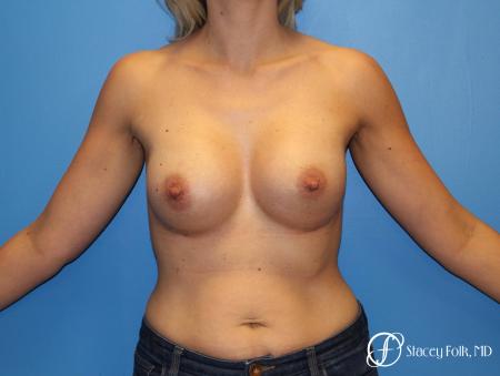 Denver Breast Augmentation 4816 - After Image 1