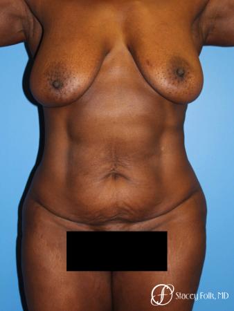 Denver Breast Lift - Mastopexy, and Tummy Tuck - Abdominoplasty 7512 - Before Image 1