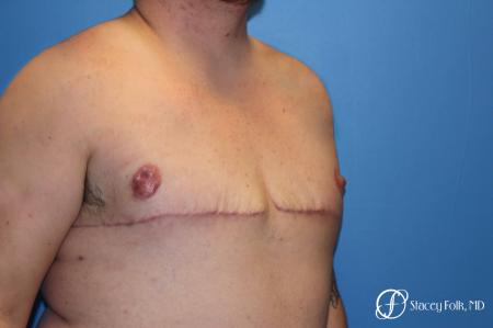 Denver FTM Female to male top surgery 5253 - After Image 2